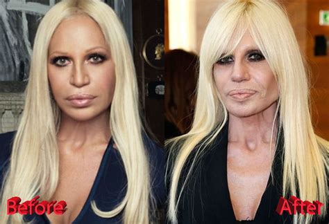 donatella versace parla della serie tv|donatella versace before and after surgery.